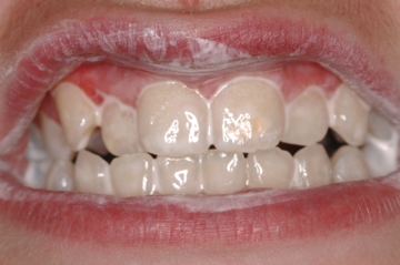 Teeth Coated with GC Tooth Mousse
