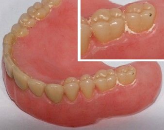 Denture weith cal -not cleaned 2nd